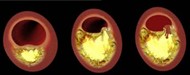 Atherosclerosis