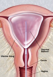Thermal ablation
