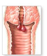 pictures of cervical polpys