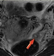 Corpus Luteum picture scan