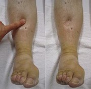 pitting edema