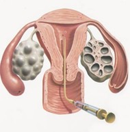 human embryo transfer