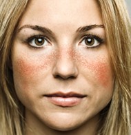 face rash