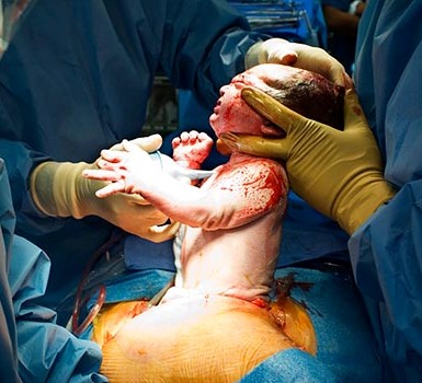 C-Section Delivery