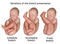 Breech