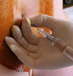Epidural Needle