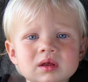 Cleft Lip after Surgery