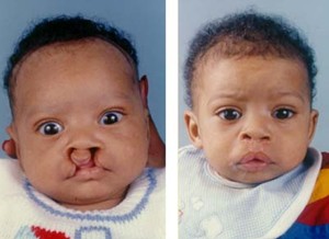 Child Before and After Surgery