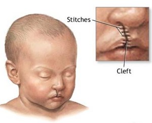 Cleft Lip After Surgery