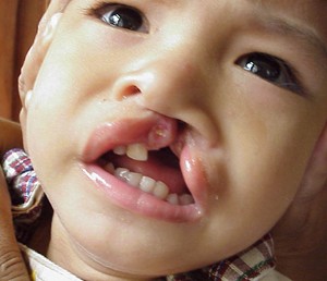 Cleft Lip