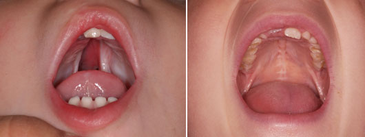 Cleft Palate After Surgery