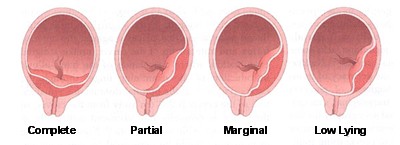 picture of low lying placenta