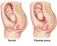 difference between normal and low lying placenta