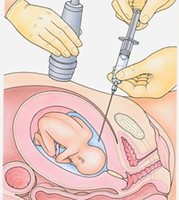 picture of pregnant woman with polyhydramnios