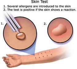 skin testing for allergies
