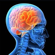 Right and Left Sided Brain Strokes