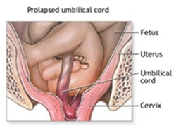 Protrudes into vagina