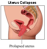 collapsed womb